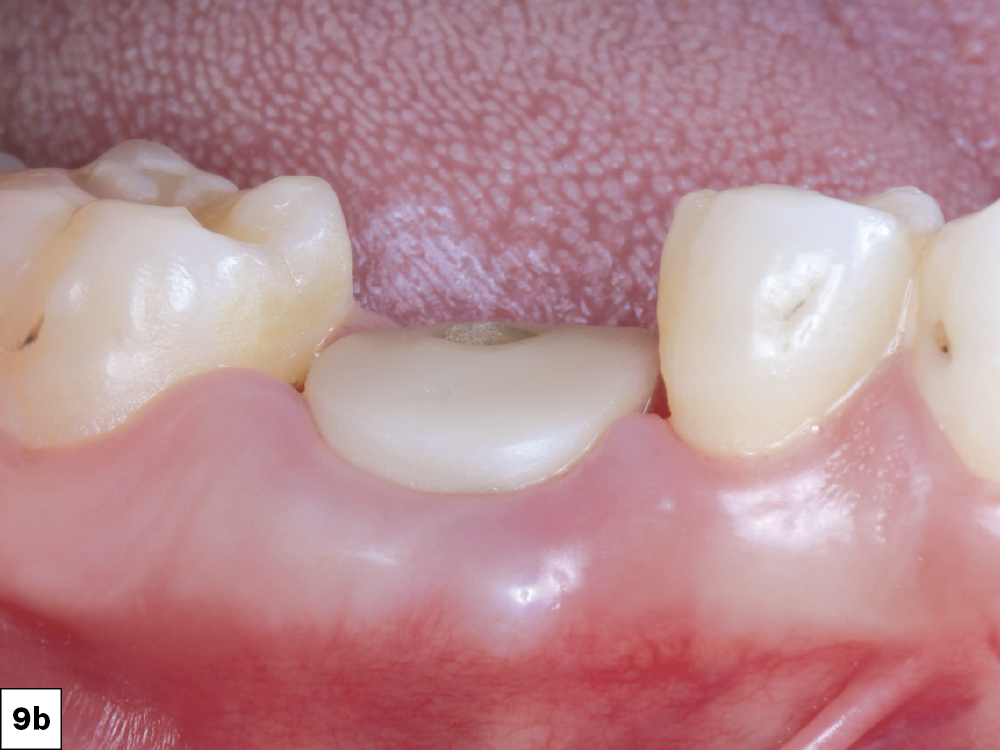 Two-week follow-up showed excellent resolution of the surgical site.