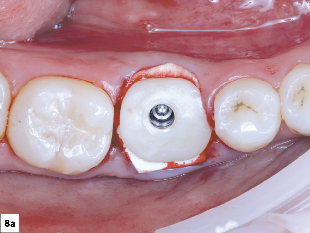 The custom healing abutment was seated after placing a layer of Newport Surgical Collagen Membrane 4–6 (Glidewell Direct) over the allograft. 
