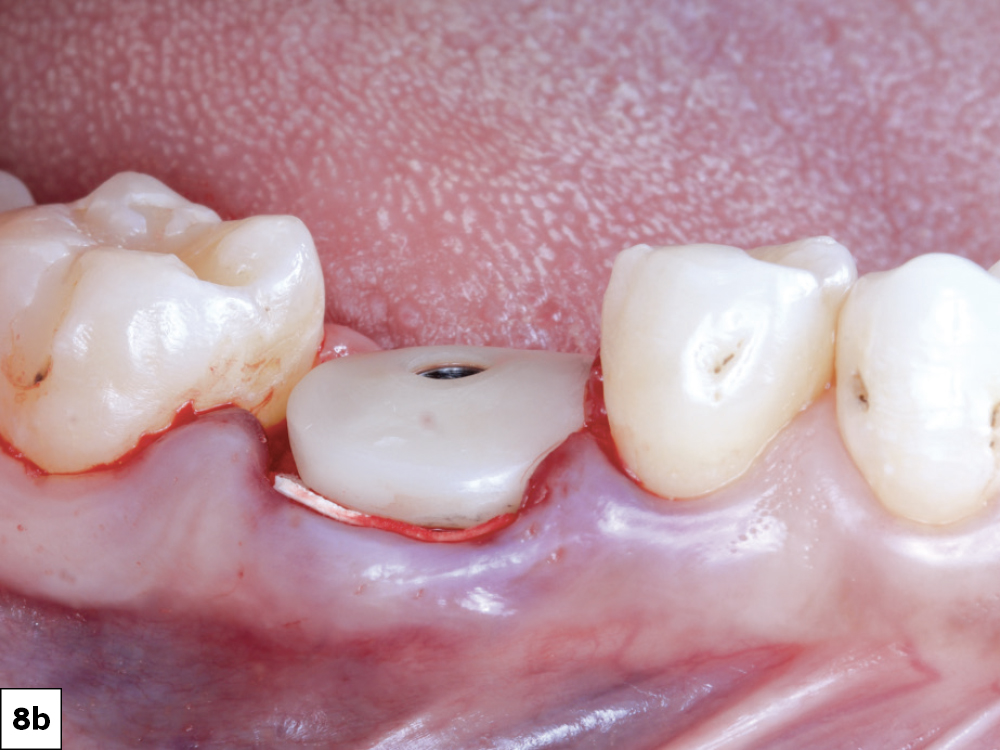 This membrane is designed to remain effective for 4–6 months, preventing the migration of soft tissue into the healing implant site.