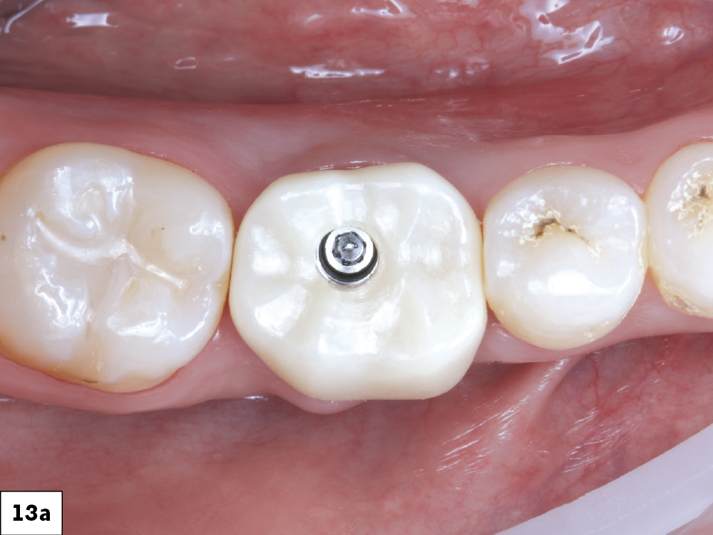 The BruxZir SRC was seated, torqued to 35 Ncm, and the screw access sealed with Teflon tape and composite resin.