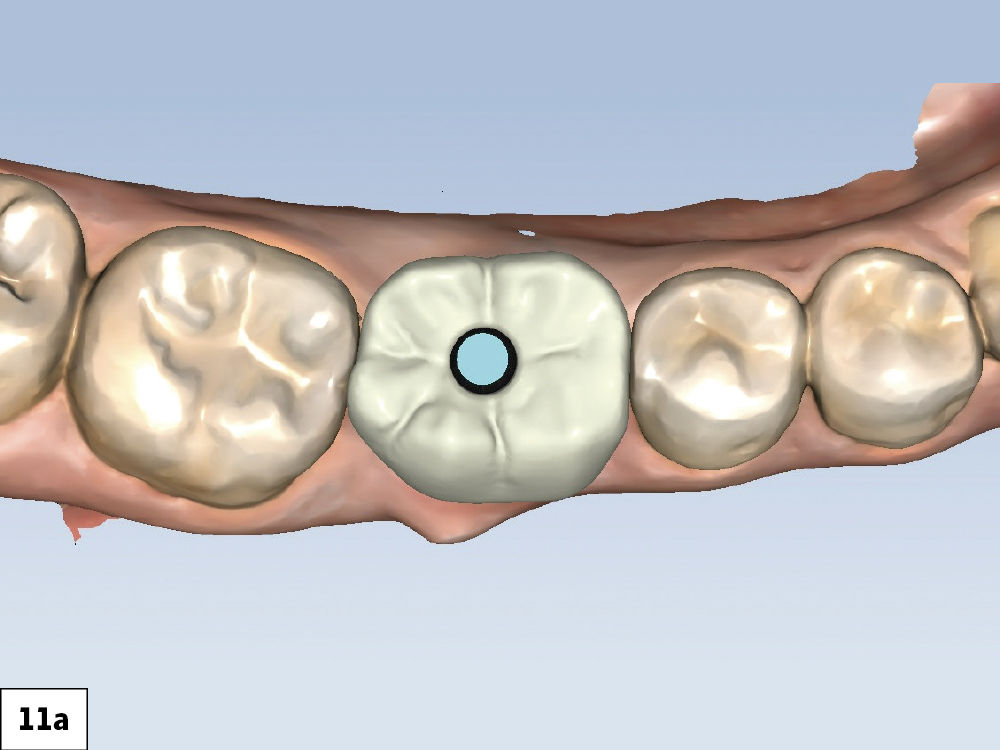Chairside design using fastdesign.io software helped determine the ideal anatomy of the BruxZir NOW screw-retained crown prior to milling.
