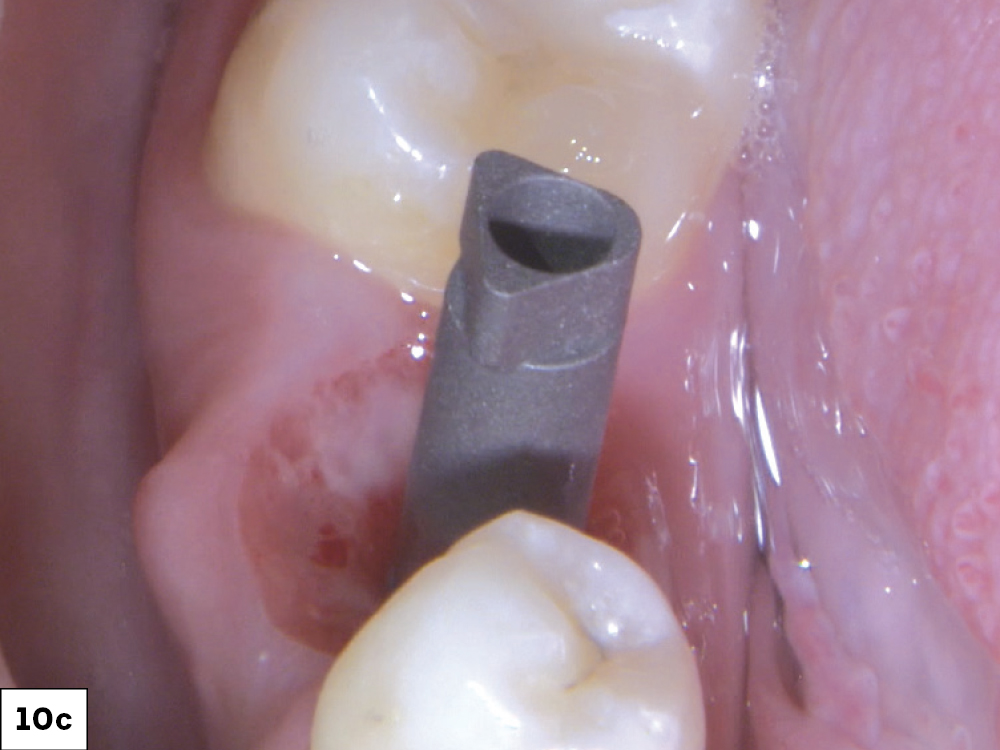 The healing abutment was removed, and a scan body was seated