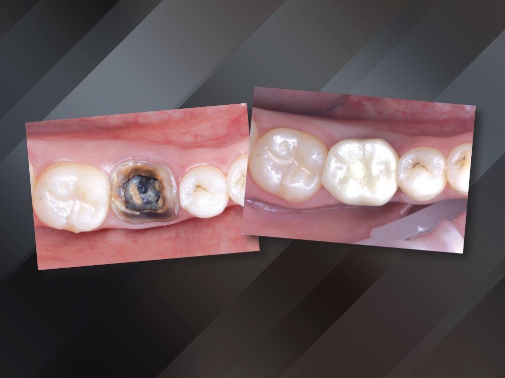 Extraction  and Immediate Implant Placement