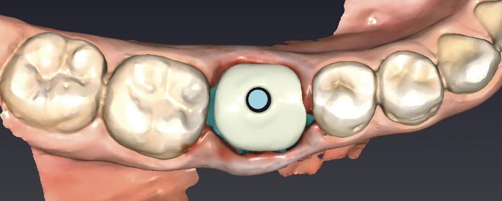A custom healing abutment was created to mimic the gingival margins of the patient’s original tooth #30 using fastdesign.io™ Software and Design Station.