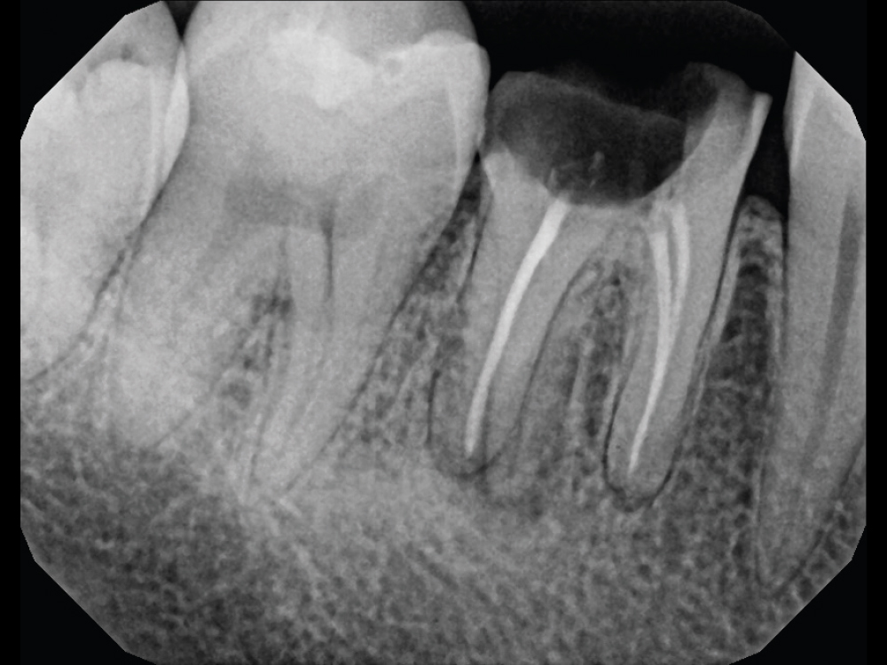 The PA radiograph revealed periapical radiolucency.