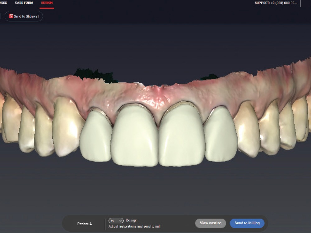 Top row of teeth in design software