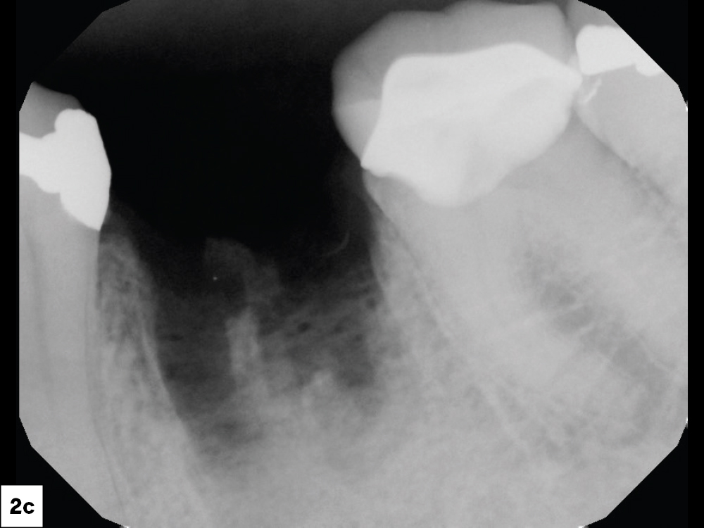 A periapical radiograph confirmed that all root structures had been removed