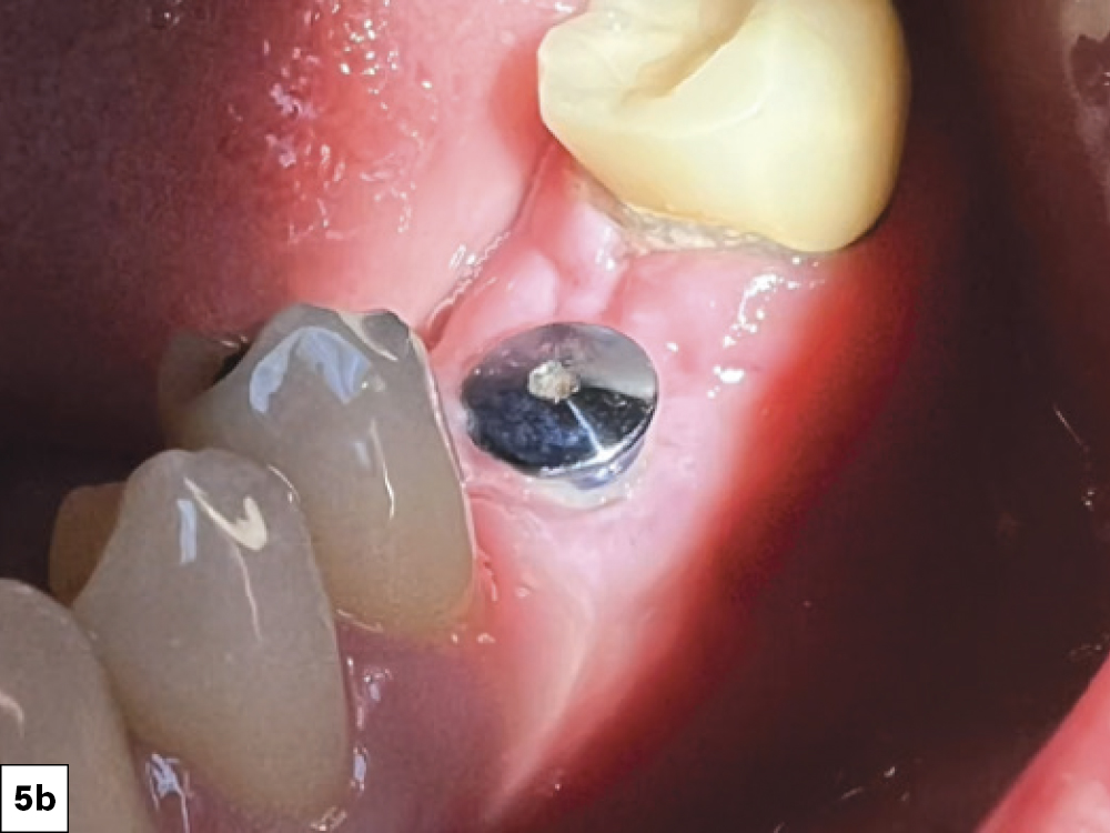 The facial reflection was then replaced and sutured, maintaining a band of attached gingiva on the facial aspect of the healing abutment