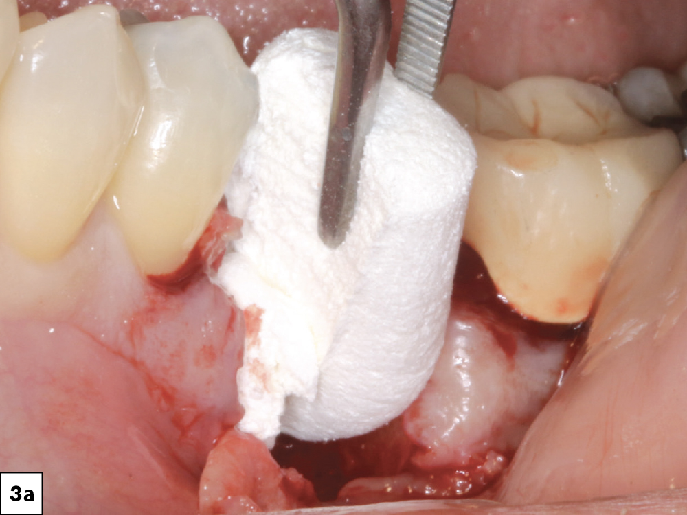 The socket was grafted using a large OsteoGen® plug 