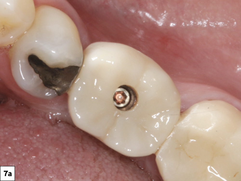 The crown was seated and the screw torqued to 35 Ncm after the occlusion and proximal contacts were verified