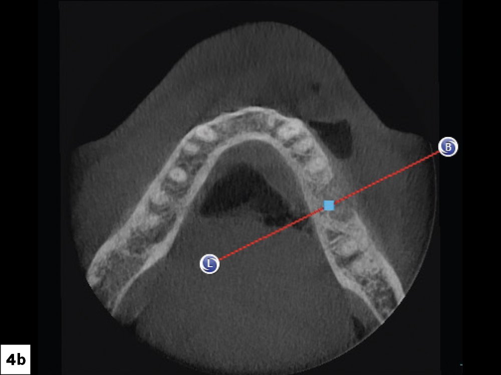 A CBCT analysis was completed, and the sagittal view helped determine that there was adequate bone for implant placement