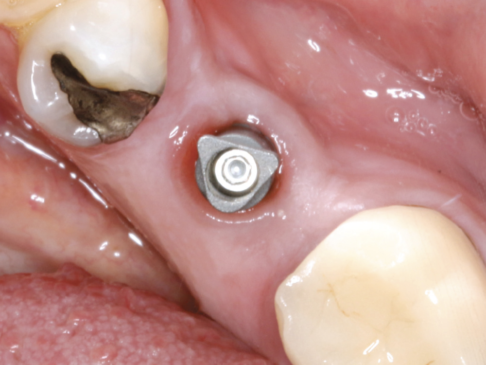  I threaded the Glidewell scan body into the implant, and an intraoral scan was recorded with a fastscan.io™ Scanning Solution featuring Medit