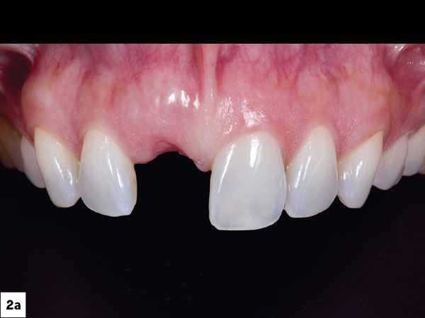 often control their smiles to reduce tooth display