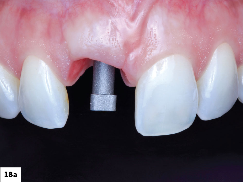A Glidewell HT™ scan body was placed, and seating was verified with a vertical bitewing