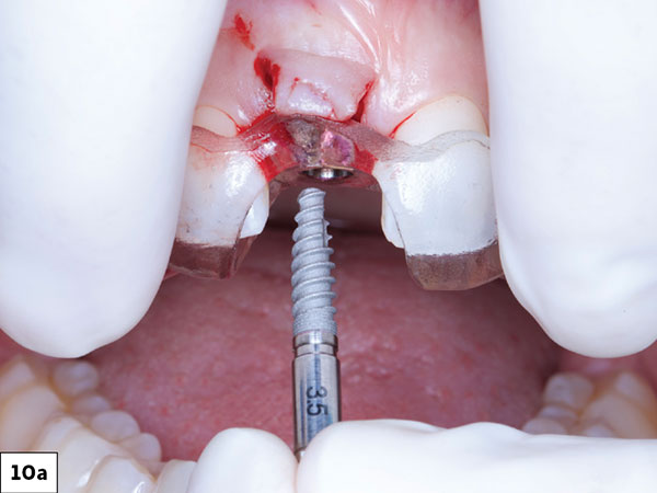 The implant was delivered through the guide, with orientation achieved by aligning the hex of the implant mount to the hex of the guide sleeve.