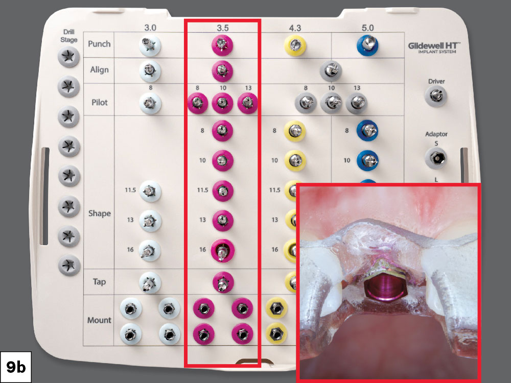 The Glidewell HT Implant Guided Surgical Kit