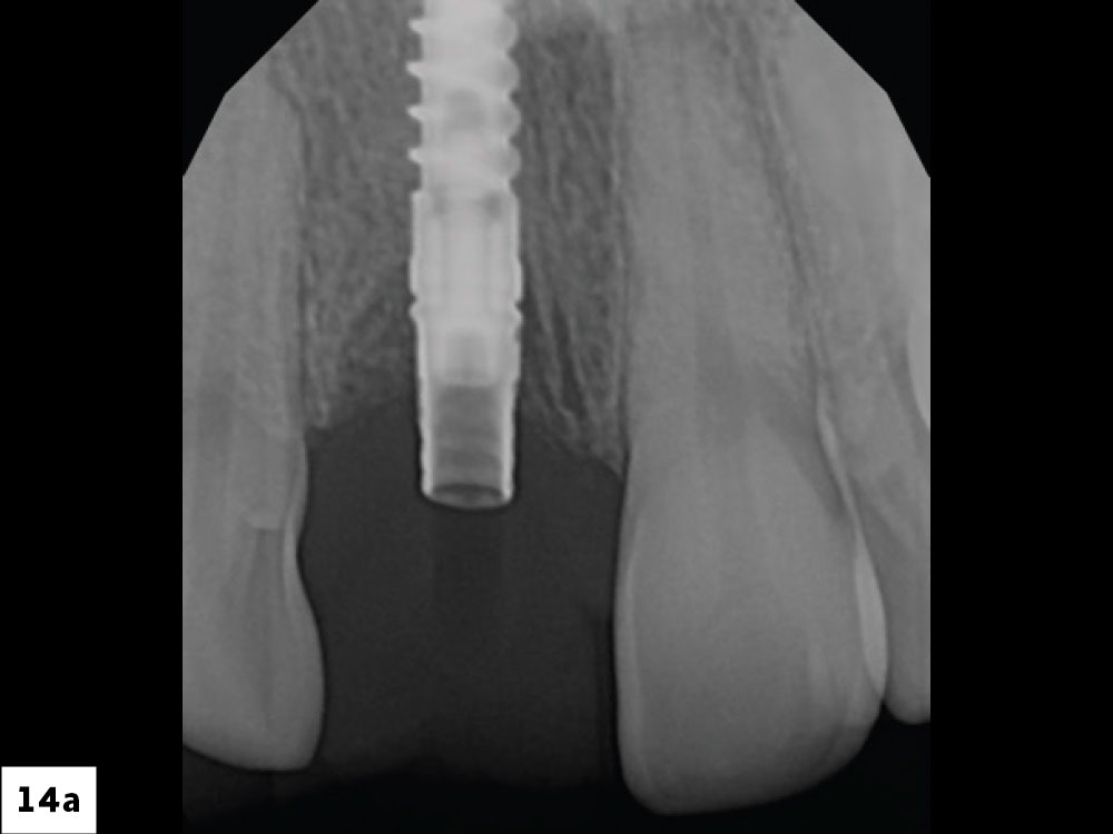 The prefabricated provisional SRC was seated and hand-tightened