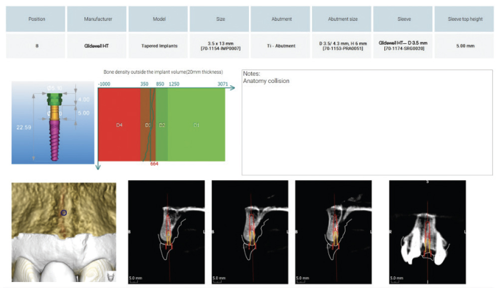 A Glidewell HT™ Implant was selected because its design is well-suited for immediate load situations