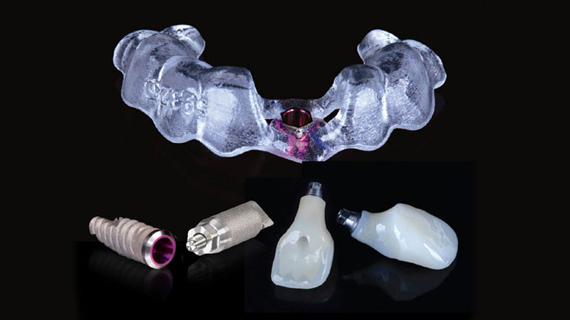 Glidewell tooth replacement