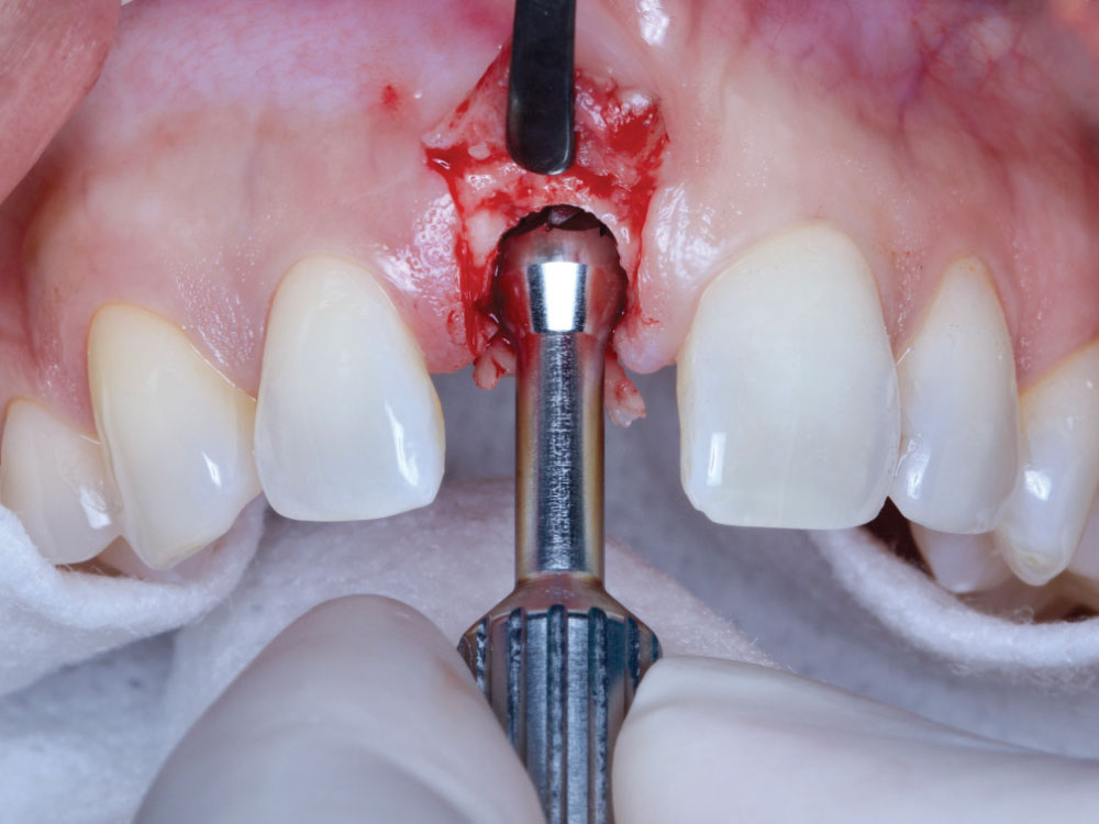 Following implant placement, a bone profiler was used to contour the crestal bone around the platform, creating a more favorable emergence profile. 10a 10b 66 chairsidemagazine.