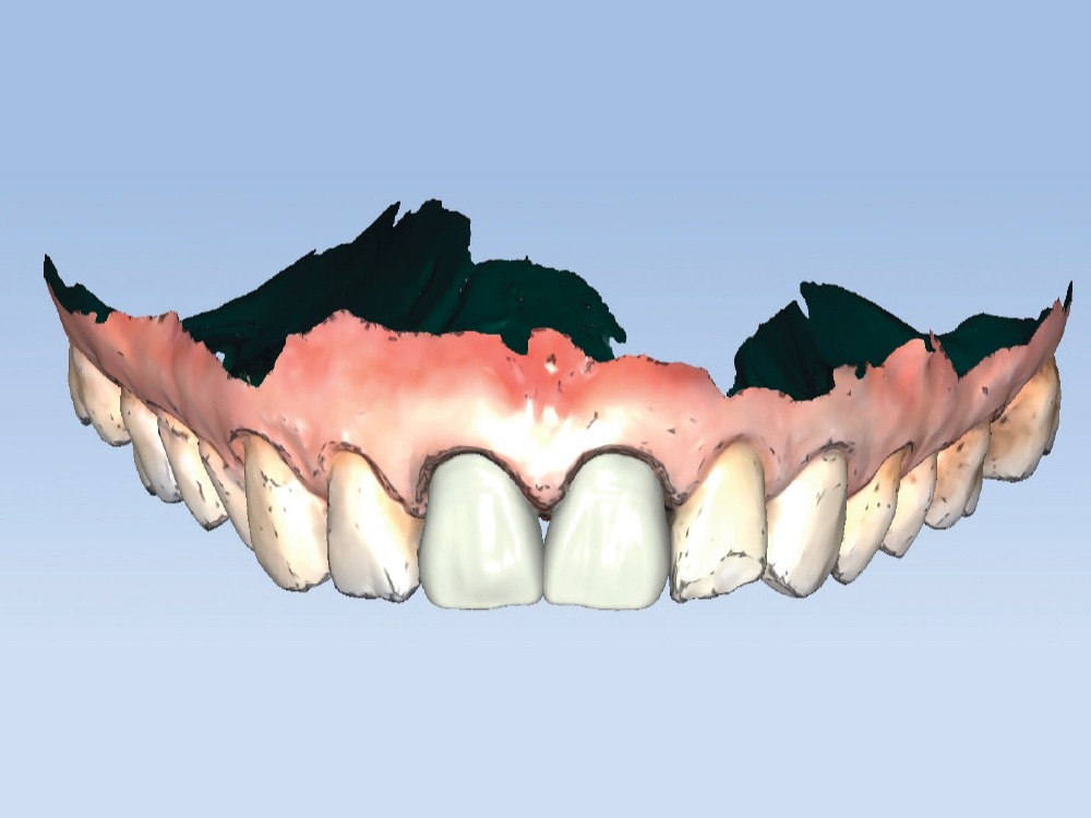 3D digital design of maxillary central incisor provisionals displayed in fastdesign.io, showing crown contours and gingival support within the full arch scan.