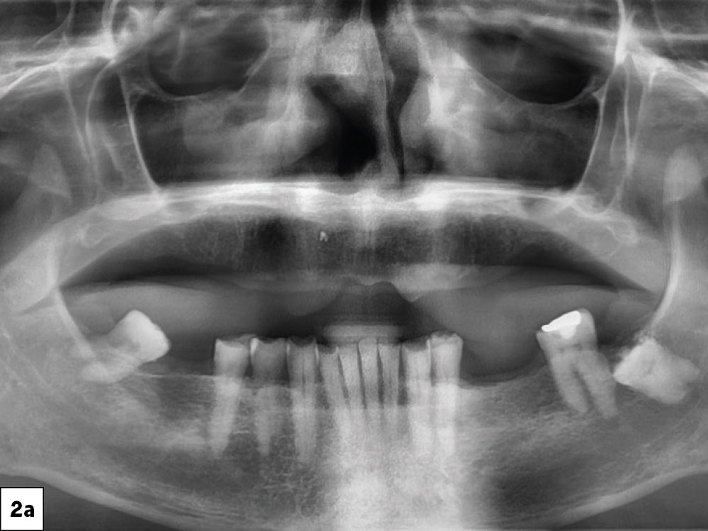 The patient presented wearing a conventional maxillary complete denture and desired something more stable and retentive.
