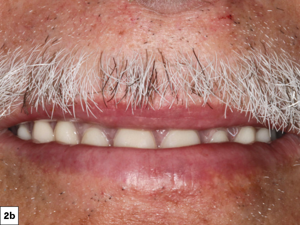 The patient presented wearing a conventional maxillary complete denture and desired something more stable and retentive.