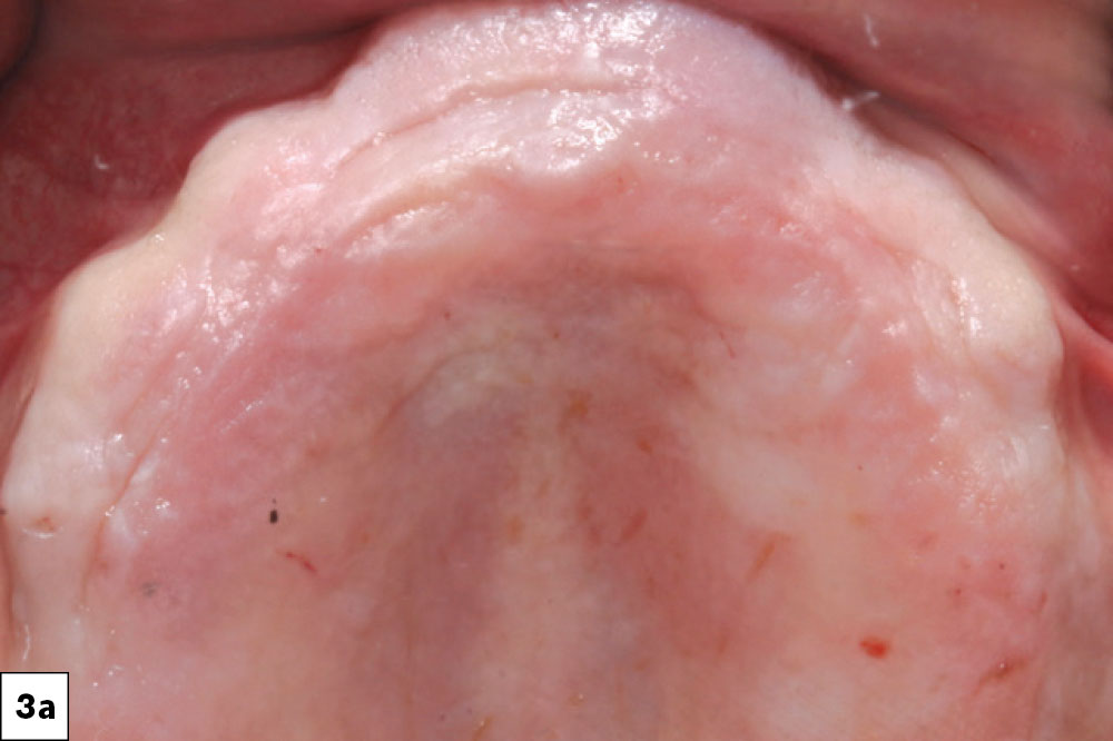 Six dental implants were surgically positioned following reflection of the tissue. Attached gingiva was repositioned to the facial aspect of the implants