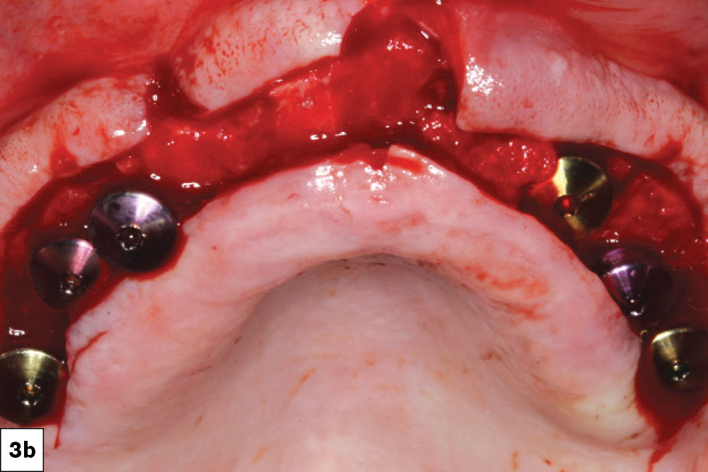 Six dental implants were surgically positioned following reflection of the tissue.