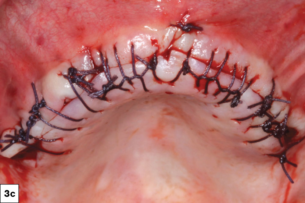 Six dental implants were surgically positioned following reflection of the tissue.