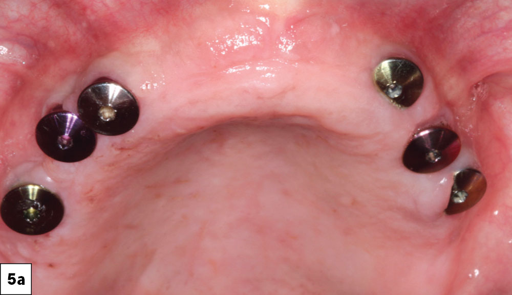 When the implants have integrated, the healing abutments are removed to facilitate the restorative procedure
