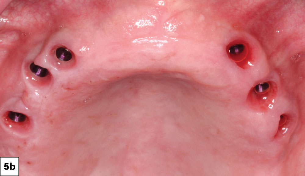 When a minimum of 25 Ncm of torque is achieved at the time of surgery, healing abutments can be placed, eliminating a second stage surgery
