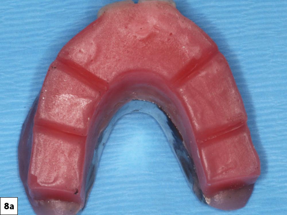 The Glidewell protocols were used to establish the desired vertical dimension and occlusal scheme.