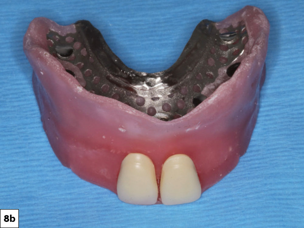 The Glidewell protocols were used to establish the desired vertical dimension and occlusal scheme.