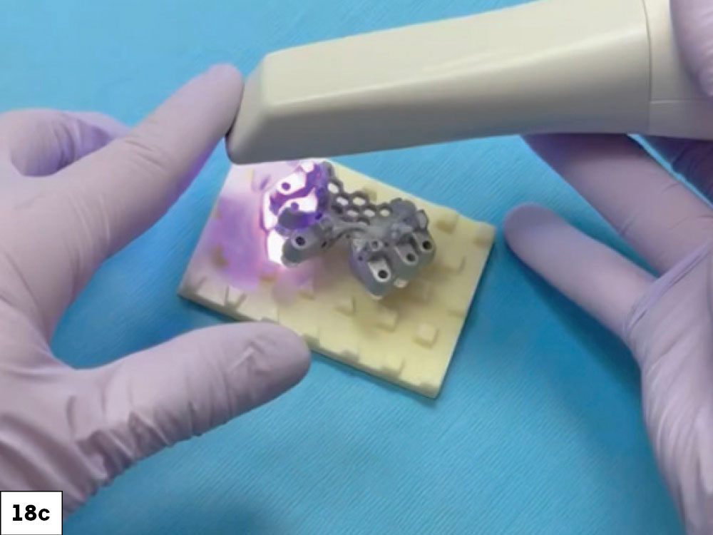 The dental lab then took this information, merged the components and fabricated the BruxZir implant-retained prosthesis
