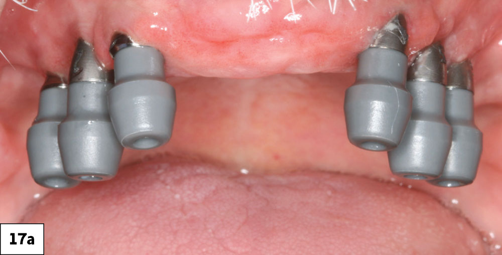An exceptionally accurate technique is the digital intraoral scanning of MUA scan bodies provided by OptiSplint® Technologies (Digital Arches; Fountain Valley, Calif.).