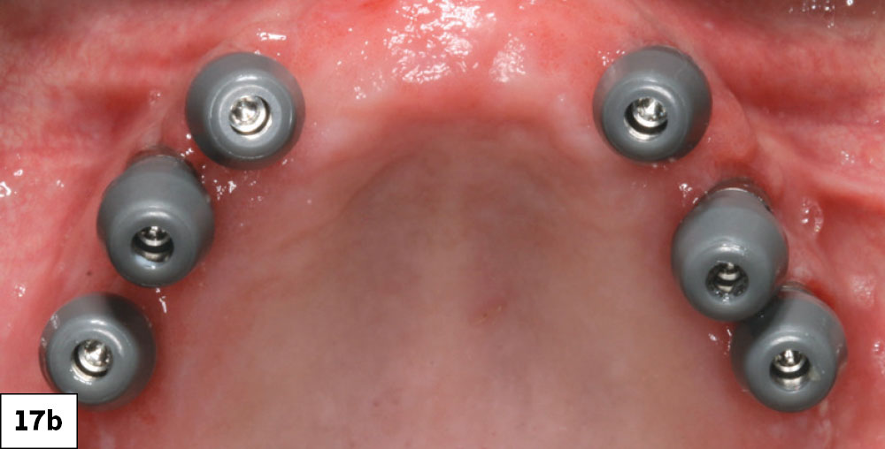 OptiSplint is a universal IVJ system and scan body used to accurately record implant positions. It works by connecting scan bodies with a frame using a luting agent material, allowing for precise, digital or analog impressions for passive-fitting prosthet