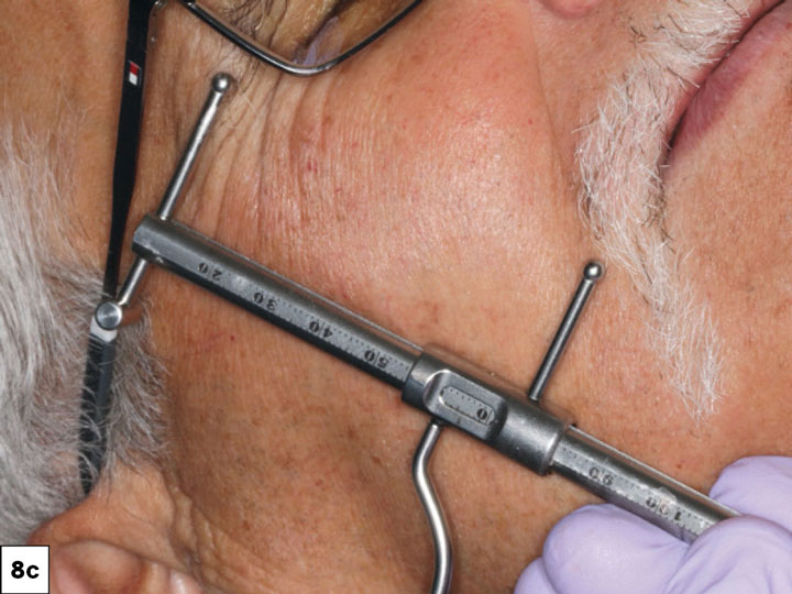 The Glidewell protocols were used to establish the desired vertical dimension and occlusal scheme
