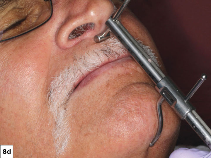 The Glidewell protocols were used to establish the desired vertical dimension and occlusal scheme