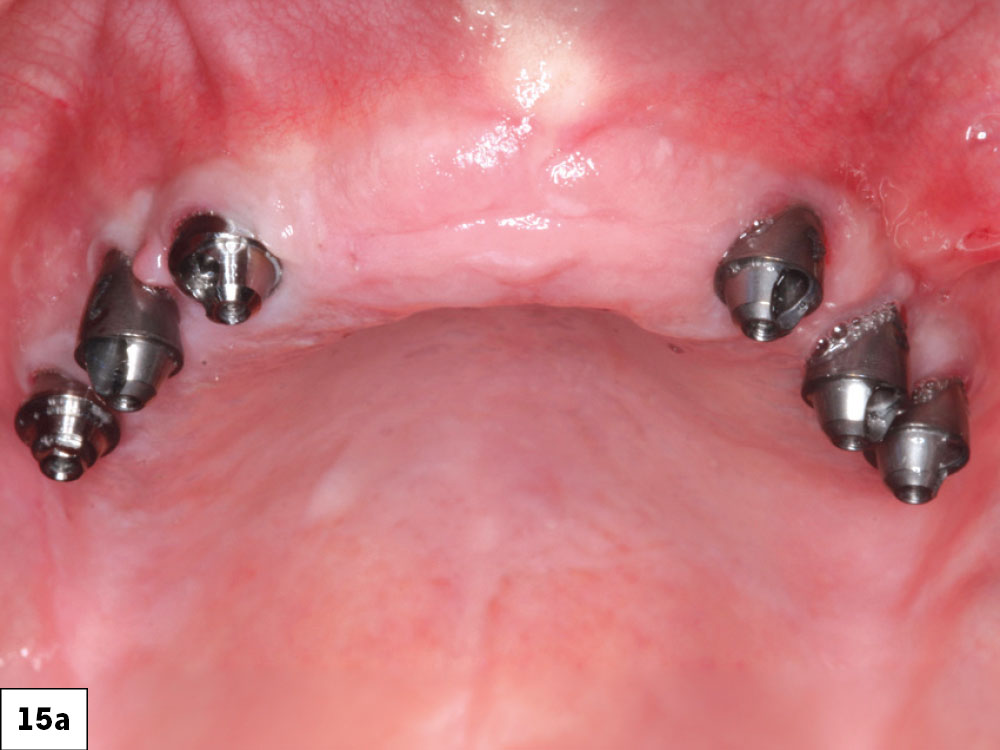 Another popular option for many patients is a full-arch, screw-retained implant-retained fixed prosthesis