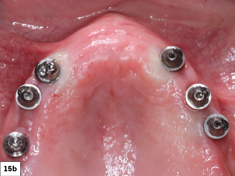 Another popular option for many patients is a full-arch, screw-retained implant-retained fixed prosthesis