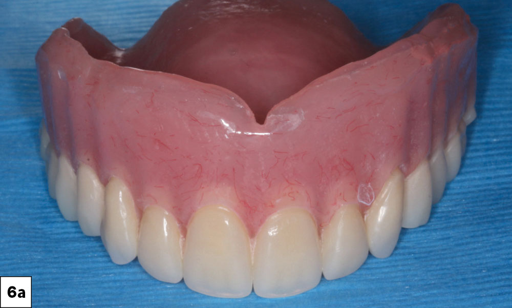 The patient wore a conventional maxillary complete denture during the four-month integration time
