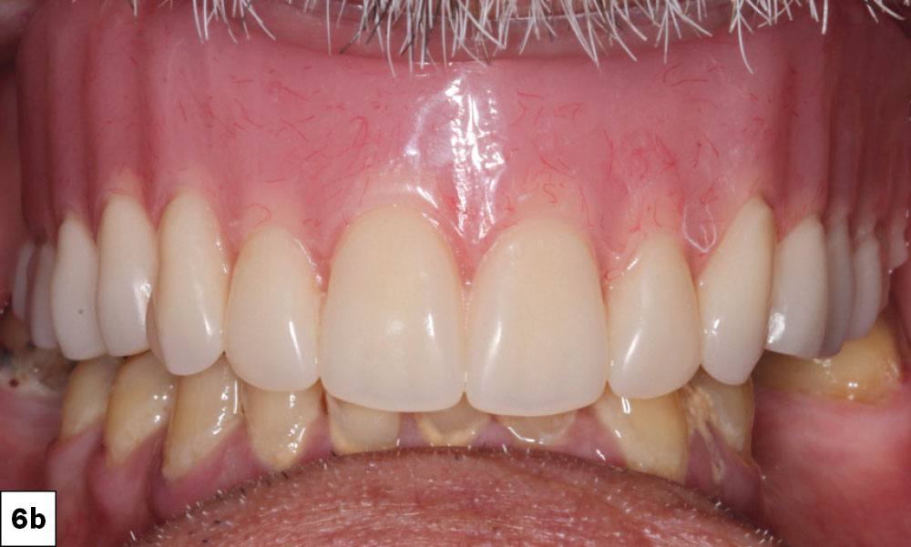 The patient wore a conventional maxillary complete denture during the four-month integration time, establishing initial esthetics and comfort with the increase in vertical dimension needed to restore the patient and improve chewing function.