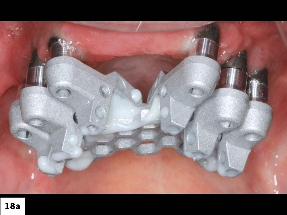 The OptiSplint components were luted together intraorally and the tissue side was scanned extraorally