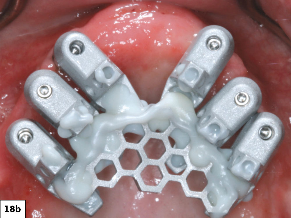 The OptiSplint components were luted together intraorally and the tissue side was scanned extraorally