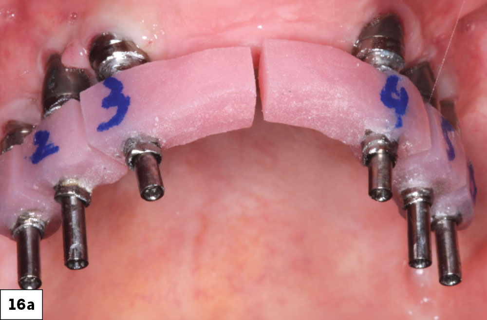 Implant verification jigs (IVJ) were fabricated by the laboratory in sections. The sections were luted together, and an analog impression was made in a custom impression tray. MUA and tissue were accurately registered