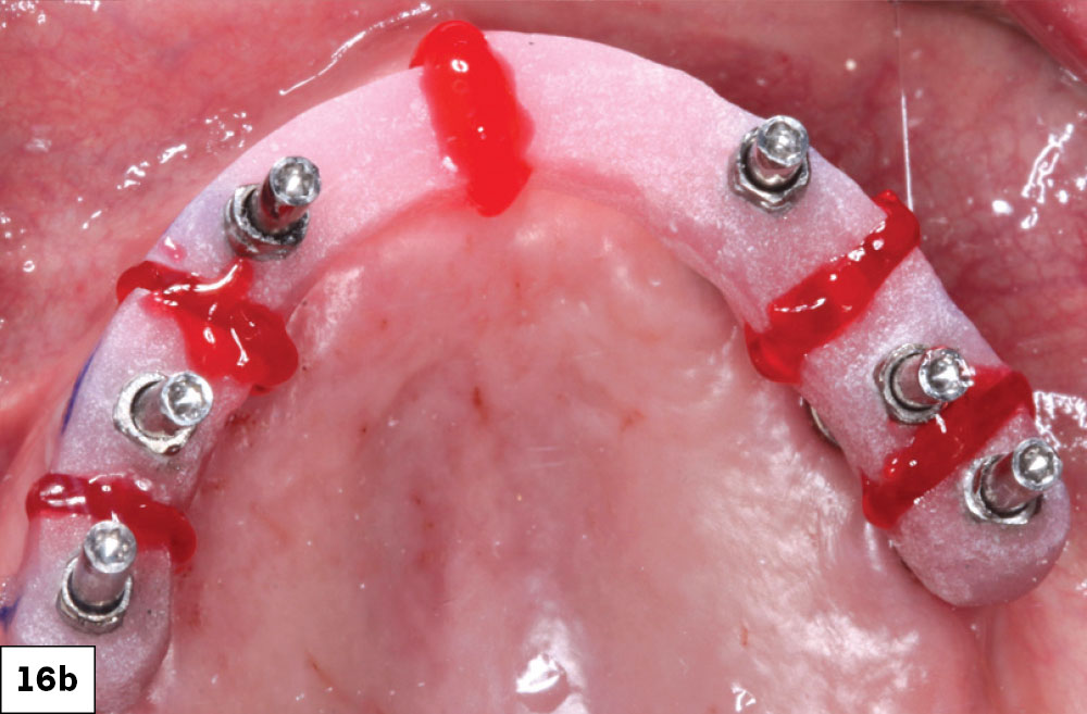 Implant verification jigs (IVJ) were fabricated by the laboratory in sections. The sections were luted together, and an analog impression was made in a custom impression tray. MUA and tissue were accurately registered