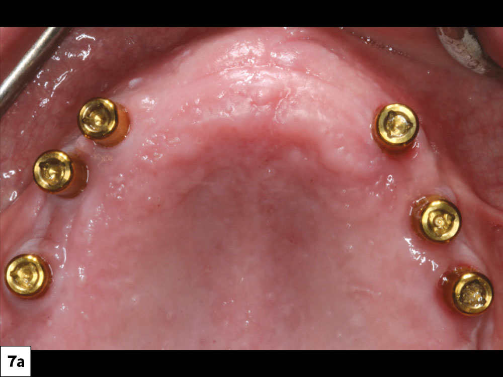 Locator attachments were chosen to extend approximately 1.5 mm above the tissue with adequate attached gingiva on the facial aspect of the implants. These supported the maxillary palateless overdenture.