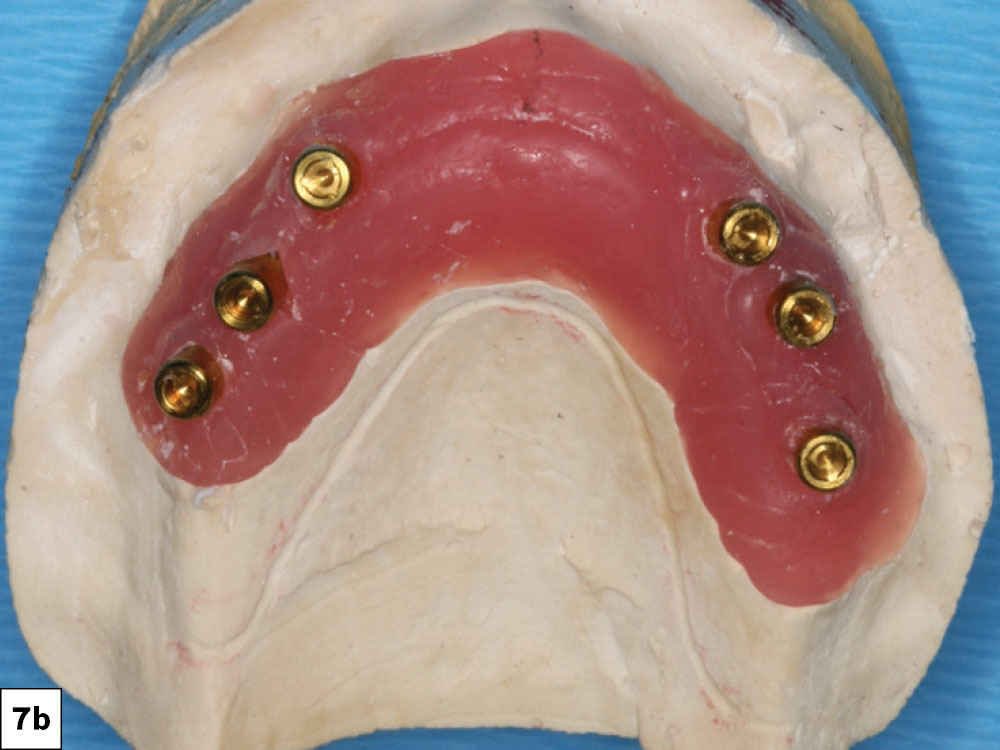 Locator attachments were chosen to extend approximately 1.5 mm above the tissue with adequate attached gingiva on the facial aspect of the implants. These supported the maxillary palateless overdenture.