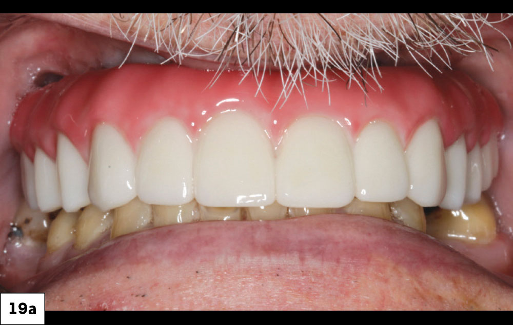 Note the freeing up of the palate. This appliance is fixed and maintained by the patient.